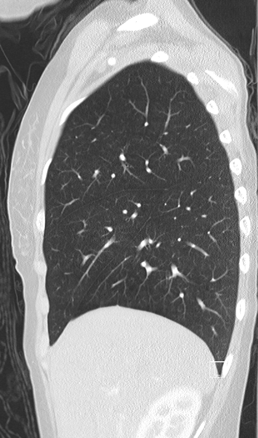 Bronchial atresia (Radiopaedia 73677-84470 Sagittal lung window 14).jpg