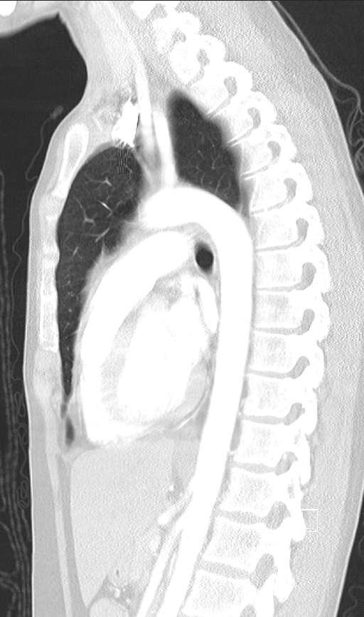 Bronchial atresia (Radiopaedia 73677-84470 Sagittal lung window 30).jpg
