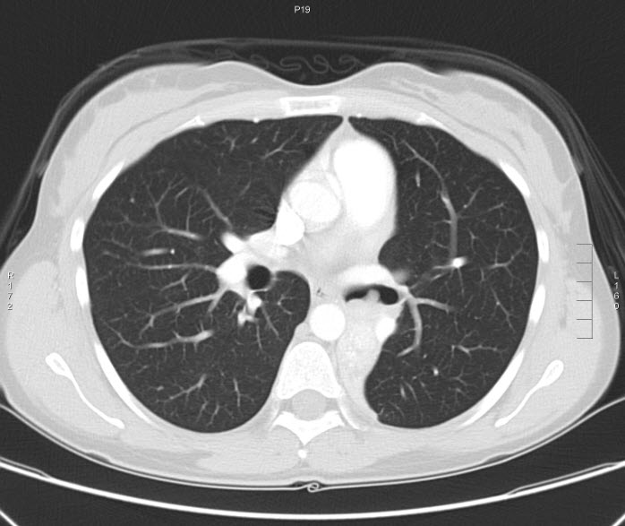 File:Bronchial carcinoid tumor (Radiopaedia 15042-42507 Axial lung window 3).jpg