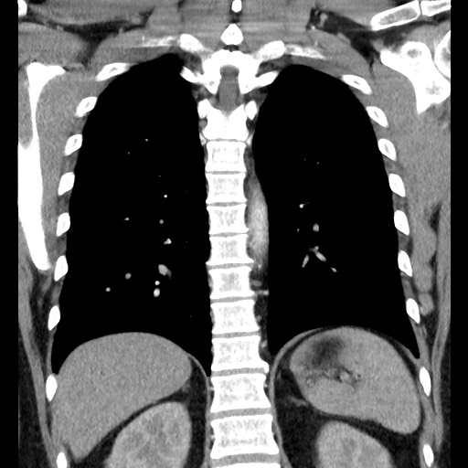 Bronchial carcinoid tumor (Radiopaedia 67377-76764 C 47).jpg