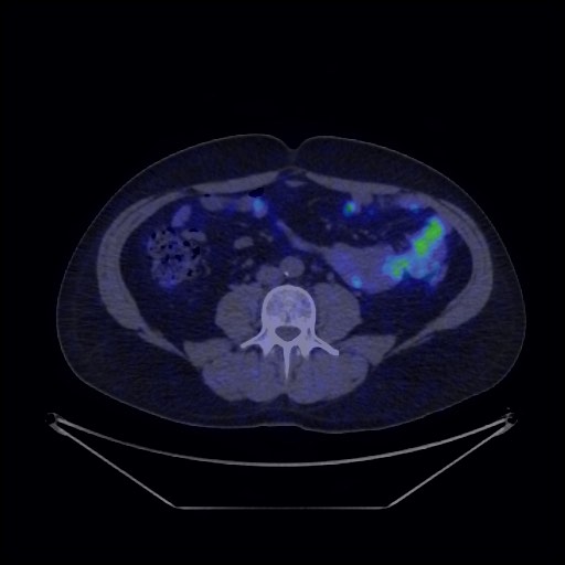Bronchial carcinoid tumor (Radiopaedia 67377-76765 68Ga-DOTATATE PET-CT 56).jpg