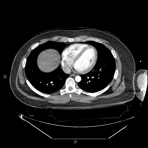 File:Bronchial carcinoid tumor (Radiopaedia 78272-90870 B 81).jpg