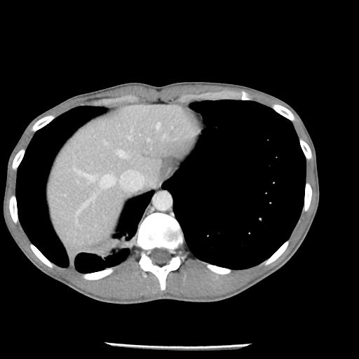 File:Bronchial carcinoid tumor causing right lower lobe collapse (Radiopaedia 83495-98594 A 46).jpg