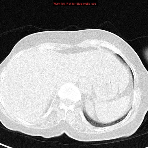 File:Bronchoalveolar carcinoma (BAC) (Radiopaedia 13436-13392 Axial lung window 45).jpg