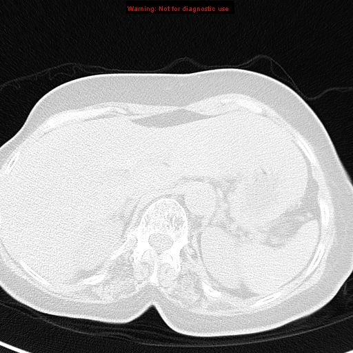 File:Bronchoalveolar carcinoma (BAC) (Radiopaedia 13436-13392 Axial lung window 48).jpg