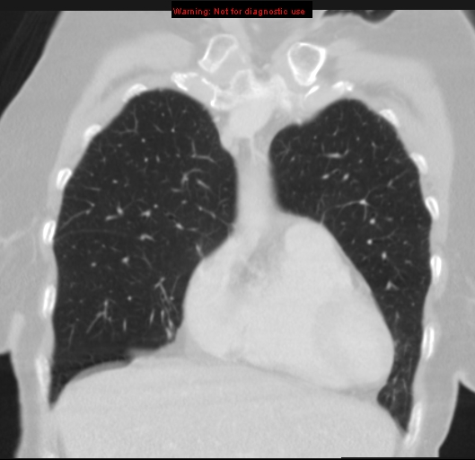 Bronchoalveolar carcinoma (BAC) (Radiopaedia 13436-13392 Coronal lung window 15).jpg
