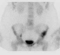 File:Bronchoalveolar carcinoma (Radiopaedia 13224-13234 A 2).jpg