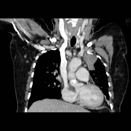 Bronchogenic carcinoma (Radiopaedia 73497-84262 C 56).jpg