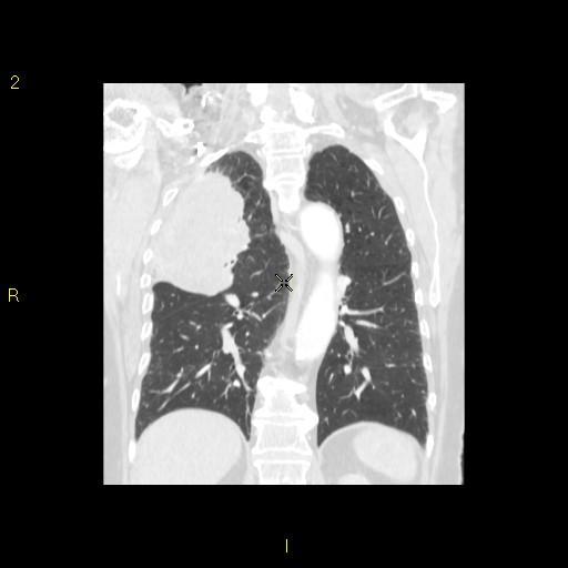 File:Bronchogenic carcinoma as an incidental finding (Radiopaedia 16453-16130 Coronal lung window 34).jpg