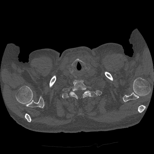 Bronchogenic carcinoma with metastatic lymphadenopathy (Radiopaedia 37671-39569 Axial bone window 1).jpg