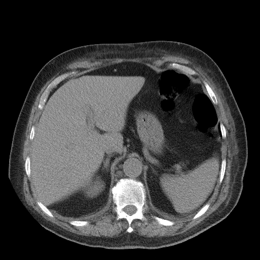 Bronchogenic carcinoma with metastatic lymphadenopathy (Radiopaedia 37671-39569 Axial non-contrast 52).jpg
