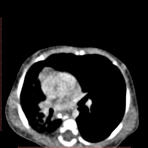 File:Bronchogenic cyst (Radiopaedia 78599-91409 B 104).jpg