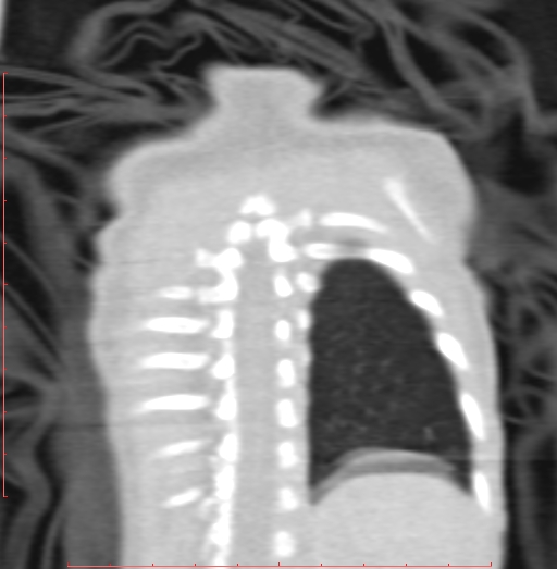 File:Bronchogenic cyst (Radiopaedia 78599-91409 Coronal lung window 196).jpg