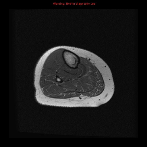File:Brown tumor (Radiopaedia 12318-12597 Axial T1 25).jpg