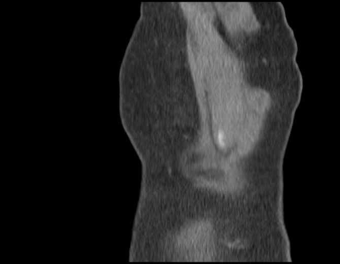 Brown tumors compressing the spinal cord (Radiopaedia 68442-77988 B 58).jpg
