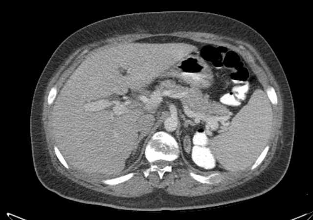 Brown tumors compressing the spinal cord (Radiopaedia 68442-77988 E 32).jpg