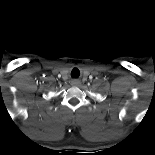 Buccal fat pad arteriovenous malformation (Radiopaedia 70936-81144 A 91).jpg
