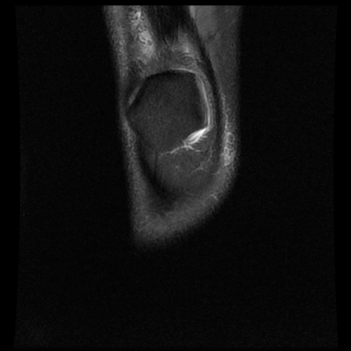 File:Bucket handle meniscus tear (Radiopaedia 56916-63751 Coronal PD fat sat 2).jpg