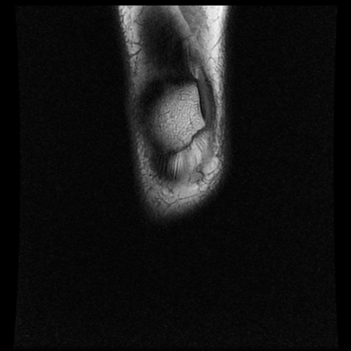 File:Bucket handle meniscus tear (Radiopaedia 56916-63751 Coronal T1 1).jpg