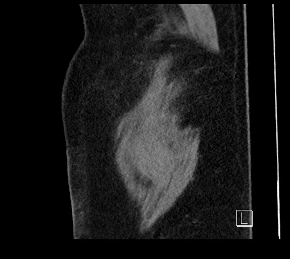 Buried bumper syndrome - gastrostomy tube (Radiopaedia 63843-72577 Sagittal Inject 3).jpg