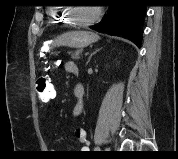 Buried bumper syndrome - gastrostomy tube (Radiopaedia 63843-72577 Sagittal Inject 44).jpg