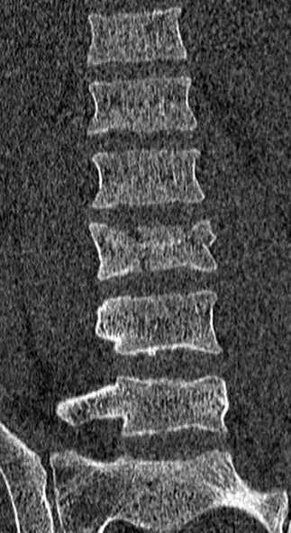 Burst fracture (Radiopaedia 53373-59357 Coronal bone window 33).jpg