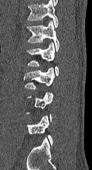 Burst fracture (Radiopaedia 53373-59357 Sagittal bone window 15).jpg