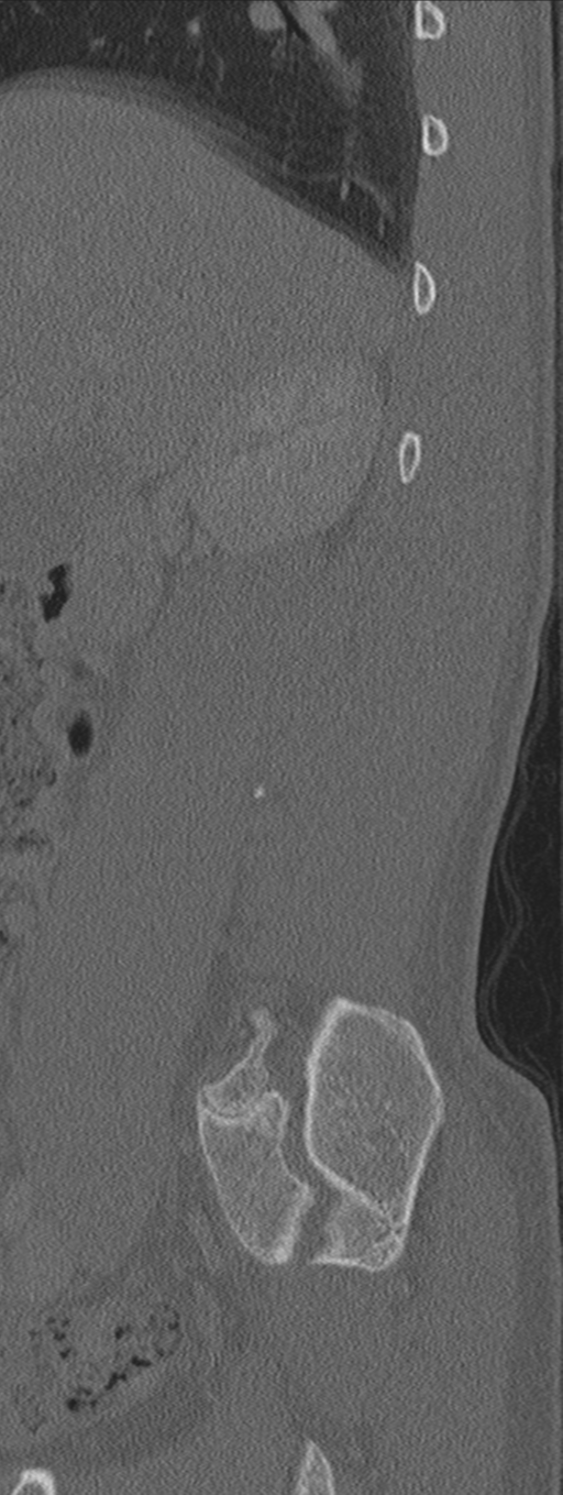 Burst fracture - T12 with conus compression (Radiopaedia 56825-63647 Sagittal bone window 74).png