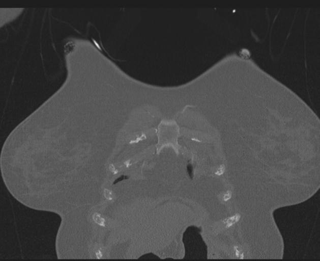 File:Burst fracture - thoracic spine (Radiopaedia 30238-30865 Coronal bone window 24).jpg