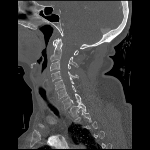 File:C1 anterior arch (plough) fracture - type 1 (Radiopaedia 76181-87720 Sagittal bone window 63).jpg