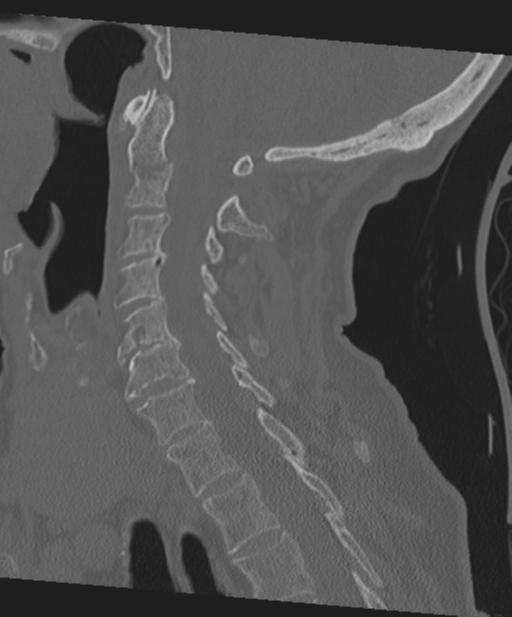 C2 fracture with vertebral artery dissection (Radiopaedia 37378-39199 Sagittal bone window 43).png