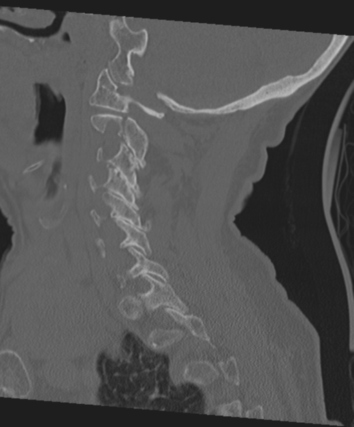 C2 fracture with vertebral artery dissection (Radiopaedia 37378-39199 Sagittal bone window 51).png