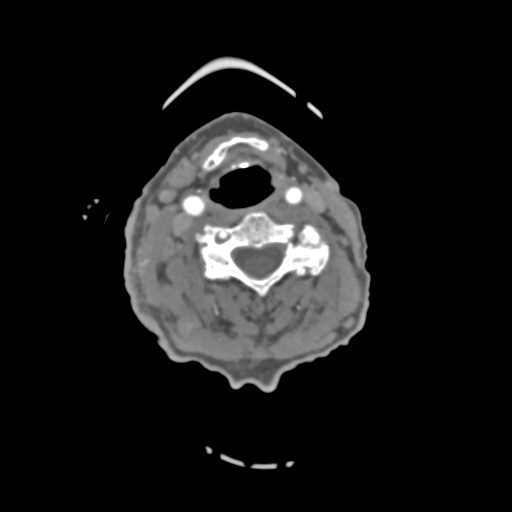 File:C2 fracture with vertebral artery dissection (Radiopaedia 37378-39200 A 131).png