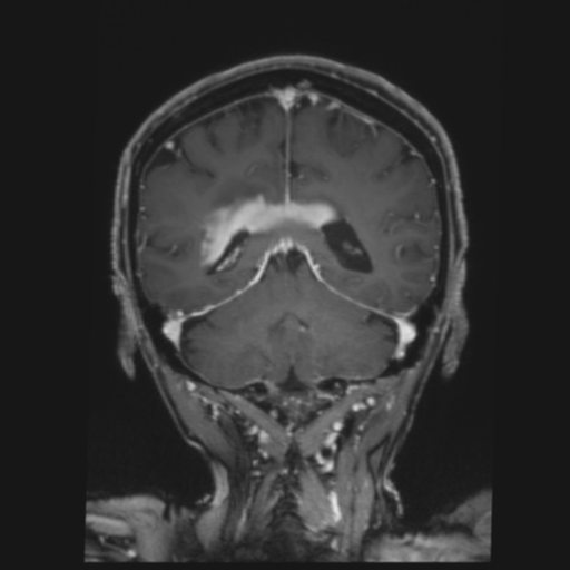 CNS lymphoma with steroid response (Radiopaedia 37980-39921 Coronal T1 C+ 33).png