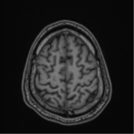 CNS vasculitis (Radiopaedia 55715-62263 Axial T1 82).png