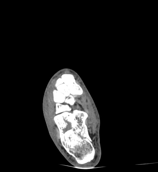 Calcaneal fracture - Sanders type 3ac (Radiopaedia 82491-96862 C 83).jpg