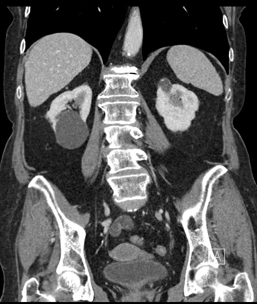 Calcified adrenal glands and Spigelian hernia (Radiopaedia 49741-54988 B 75).jpg