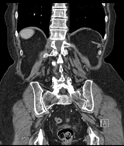 Calcified adrenal glands and Spigelian hernia (Radiopaedia 49741-54988 B 90).jpg