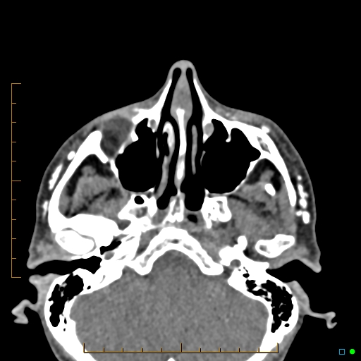 Calcified facial augmentation fillers (Radiopaedia 79514-92679 Axial non-contrast 16).jpg