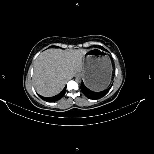 File:Calcified hepatic hydatid cyst (Radiopaedia 84672-100095 Axial non-contrast 20).jpg