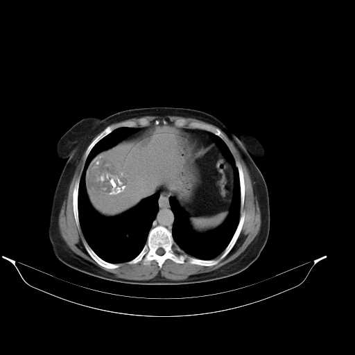 File:Calcified hydatid cyst of the liver (Radiopaedia 21212-21112 Axial C+ delayed 9).jpg