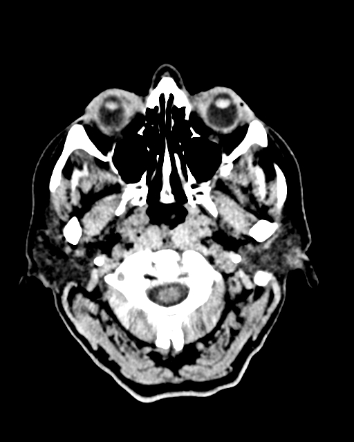 Calcified meningioma (Radiopaedia 74361-85243 Axial non-contrast 50).jpg