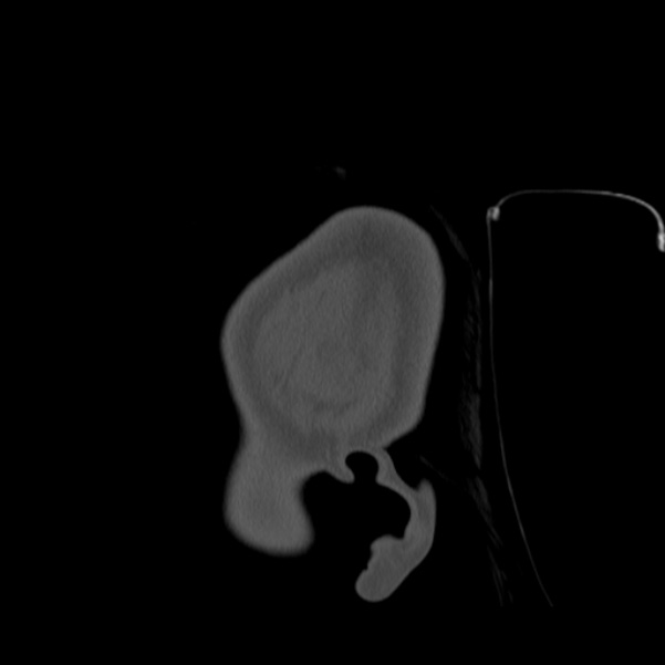 Calvarial osteoma (Radiopaedia 36520-38079 Sagittal bone window 106).jpg