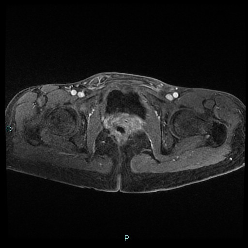 File:Canal of Nuck cyst (Radiopaedia 55074-61448 Axial T1 C+ fat sat 43).jpg