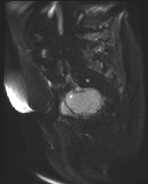 Cancer cervix - stage IIb (Radiopaedia 75411-86615 Sagittal DWI 40).jpg