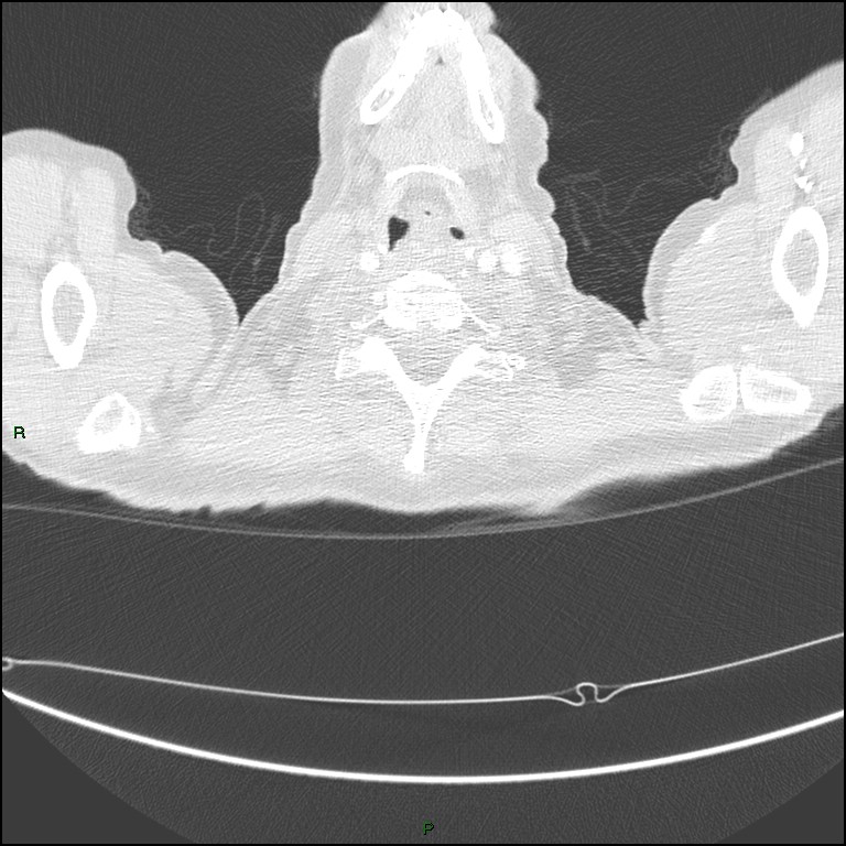 Cannonball metastases (Radiopaedia 82110-96150 Axial lung window 3).jpg