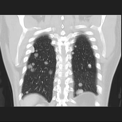 File:Cannonball pulmonary metastases (Radiopaedia 67684-77101 C 21).jpg