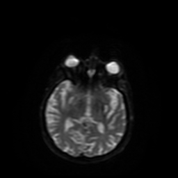 File:Carcinoma ex-pleomorphic adenoma of parotid (Radiopaedia 28383-28627 Ax DWI B-500 GE 34).jpg