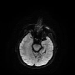 Carcinoma ex-pleomorphic adenoma of parotid (Radiopaedia 28383-28627 Ax DWI B-500 GE 68).jpg