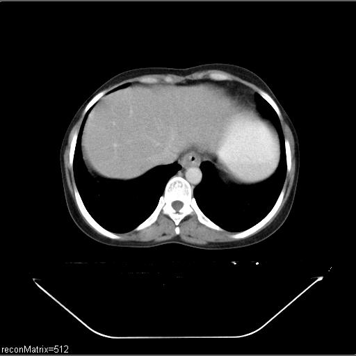 File:Carcinoma of esophagus (Radiopaedia 27356-27550 A 9).jpg